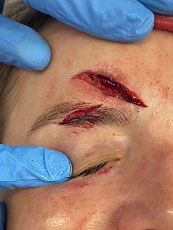 Page Fuller laceration